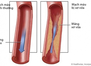 Cao huyết áp, yếu tố nguy cơ gây xơ vữa động mạch
